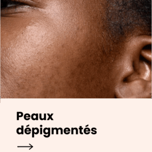 Peaux dépigmentées en transtion