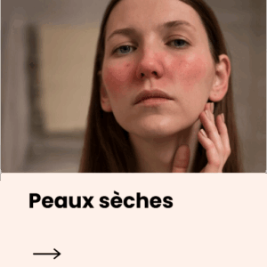Peaux sèches